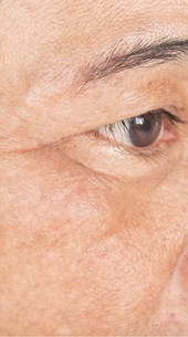 درمان-دور-چشم؛-جوانسازی-و-رفع-تیرگی-و-سیاهی