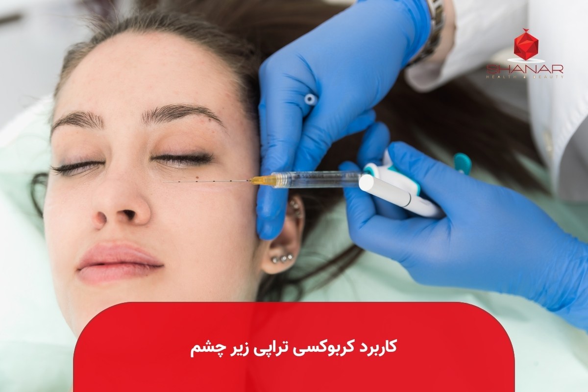 کاربرد-کربوکسی-تراپی-زیر-چشم